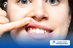 Mengungkap Makanan Yang Memicu Gusi Berdarah Panduan Lengkap Untuk Kesehatan Mulut Optimal